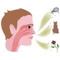 allergic rhinitis. Disease, with swelling and inflammation of the nasal mucosa.